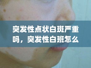 突发性点状白斑严重吗，突发性白班怎么治疗 