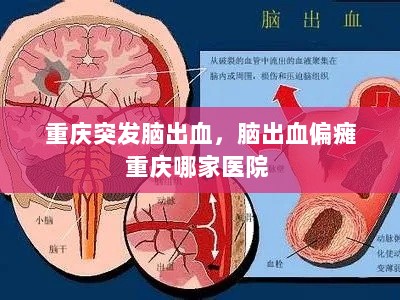 重庆突发脑出血，脑出血偏瘫重庆哪家医院 